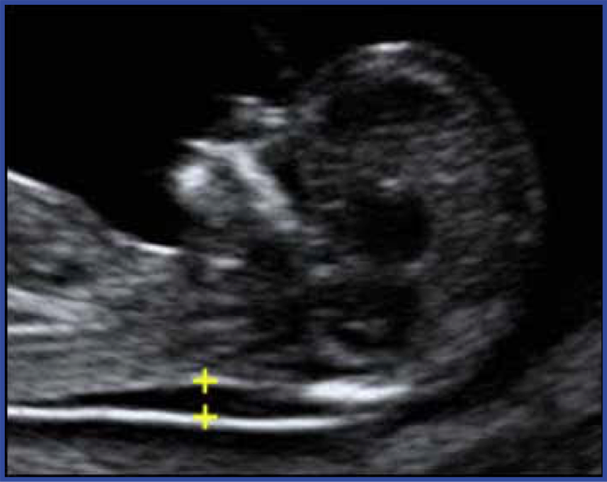 nuchal translucency measurement